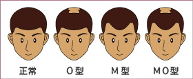 正常 O型 M型 MO型
