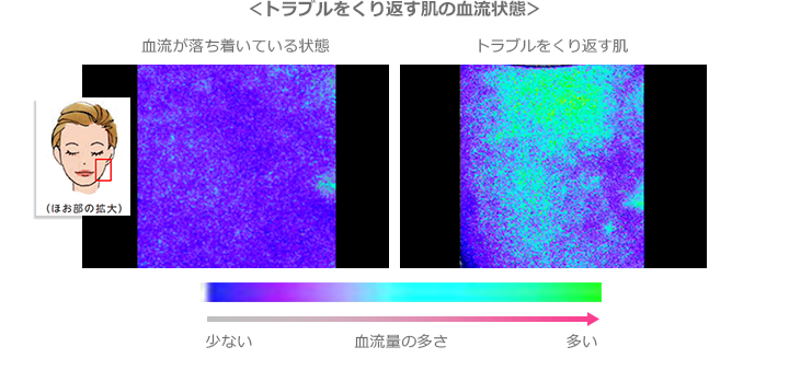 トラブルをくり返す肌の血流状態