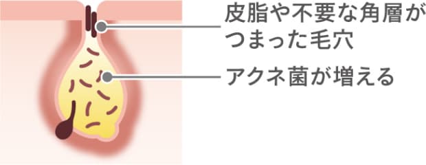 毛穴断面図 皮脂や不要な角層がつまった毛穴 アクネ菌が増える