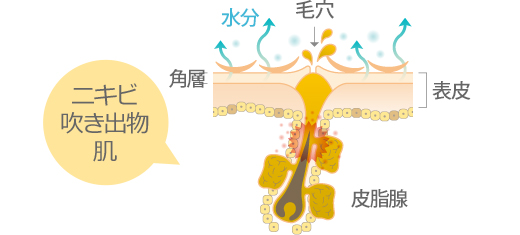 ニキビ・吹き出物肌の断面図