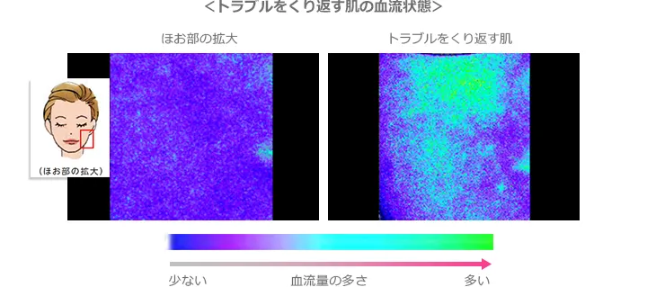 トラブルをくり返す肌の血流状態