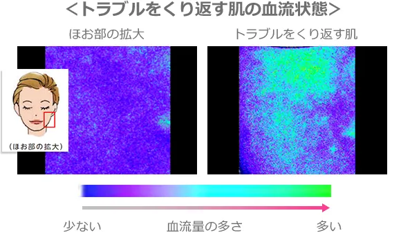 トラブルをくり返す肌の血流状態