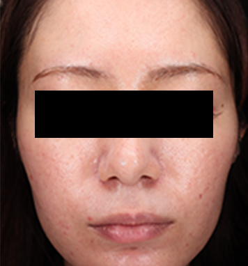 通常の肌の撮影の画像