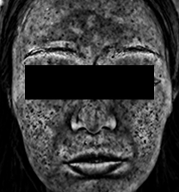 特殊カメラで肌を撮影した画像