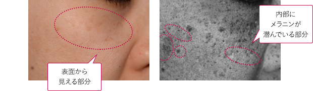 表面から見える部分 内部にメラニンが潜んでいる部分