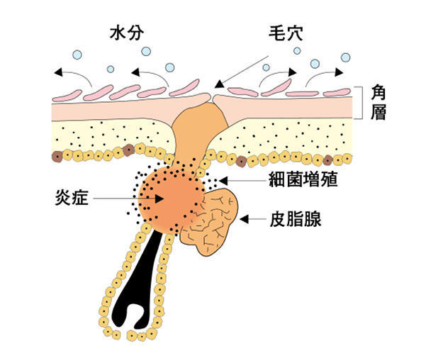 頑固なニキビを作りたくない おすすめの対策法 ニキビ跡を消すメイク術 美容の情報 ワタシプラス 資生堂