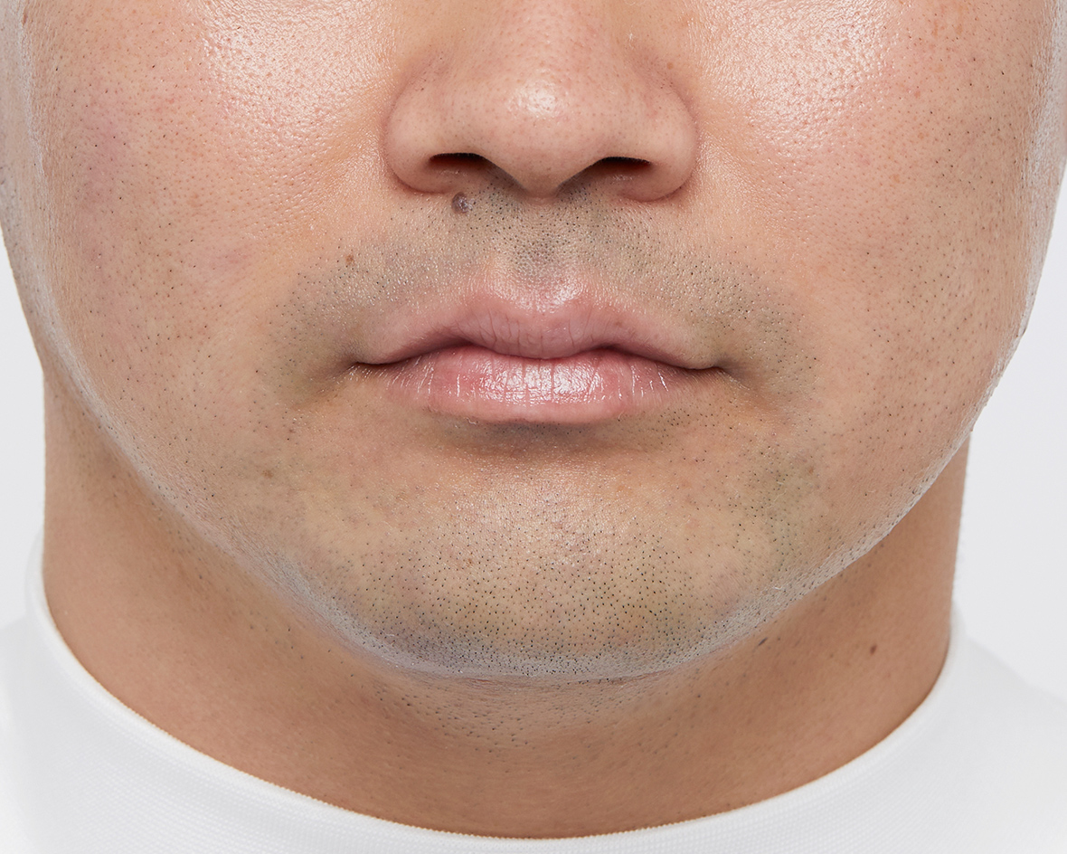 ひげの青みのビフォー画像