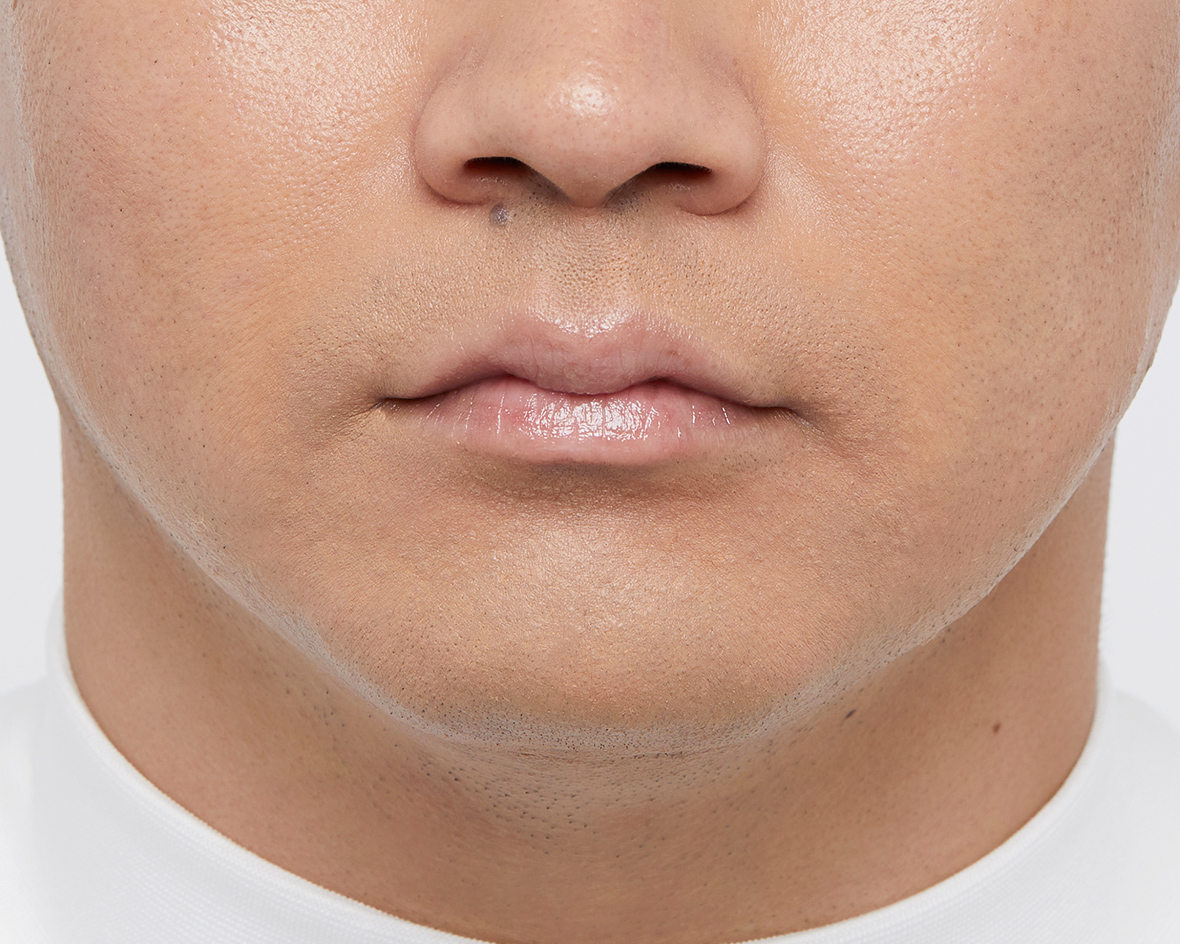 ひげの青みのアフター画像