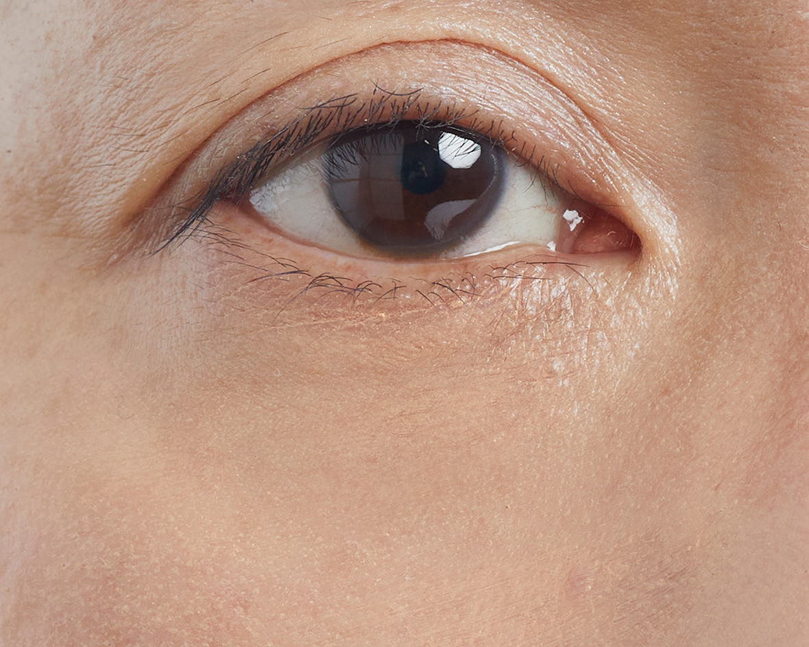 目の周りのクマのアフター画像