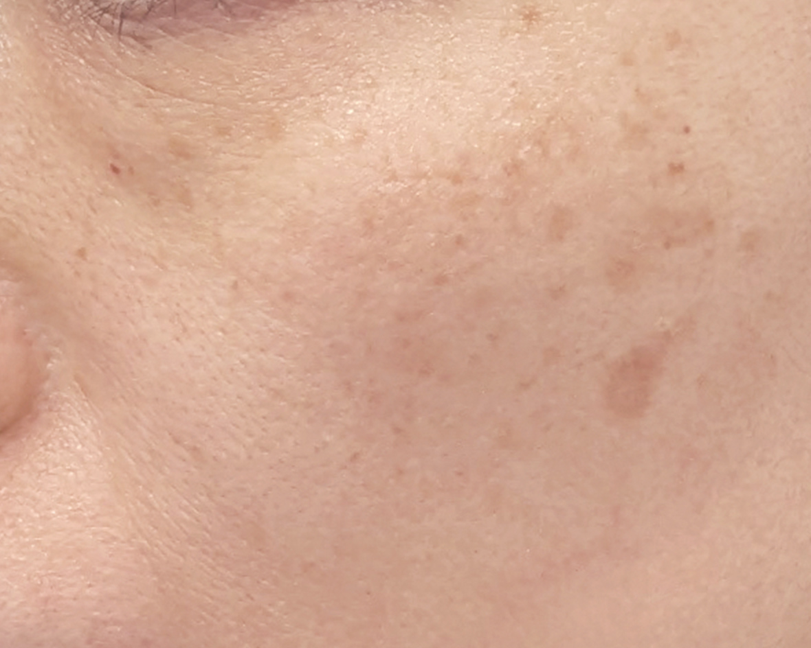 顔にあるシミ、そばかすのビフォー画像