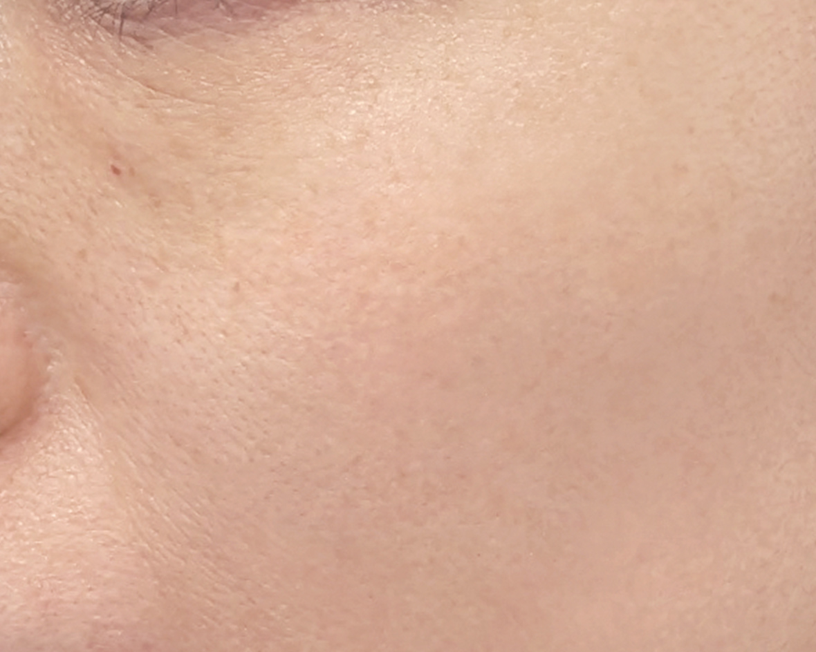 顔にあるシミ、そばかすのアフター画像